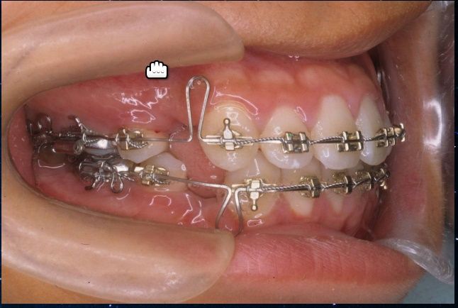 Sơ lược về loop trong chỉnh răng