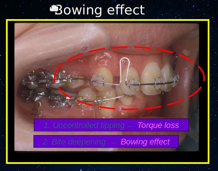 Bowing effect là gì