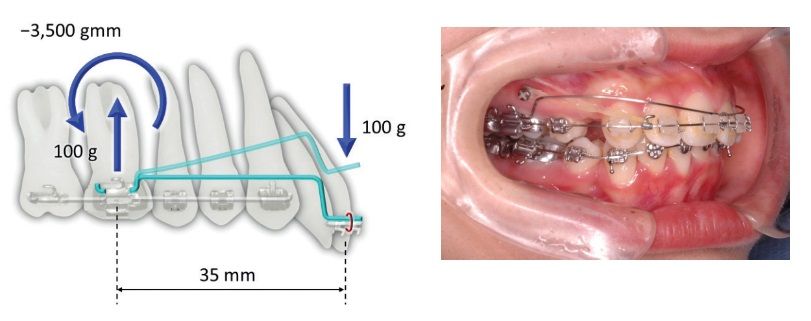 Khái niệm lực và mô men lực trong chỉnh răng