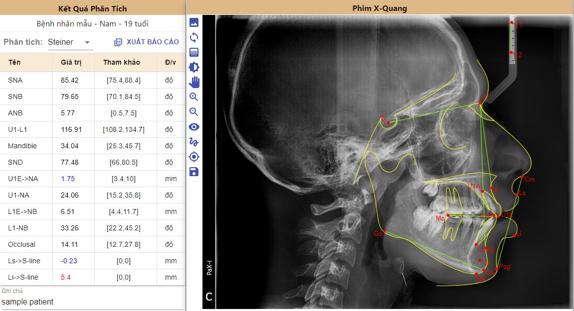 Chụp màn hình phần mềm phân tích phim sọ mặt nghiêng ViCeph