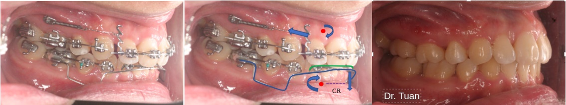 Đánh giá vị trí tâm cản của nhóm răng cửa hàm trên và hàm dưới để tìm hướng lực