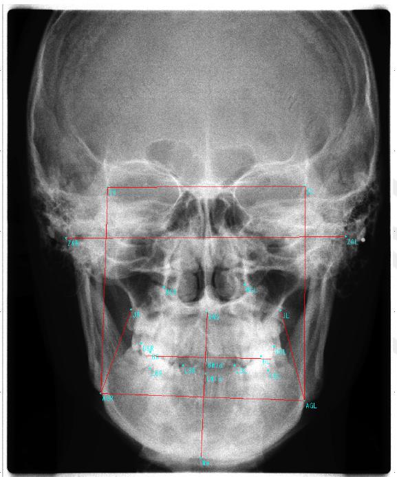 Các điểm phân tích và mặt phẳng dựng trên phim sọ mặt thẳng 