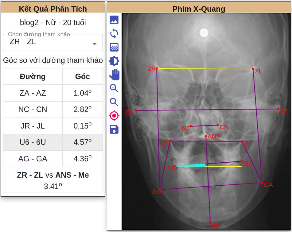 Phân tích phim sọ mặt thẳng bằng phần mềm ViCeph