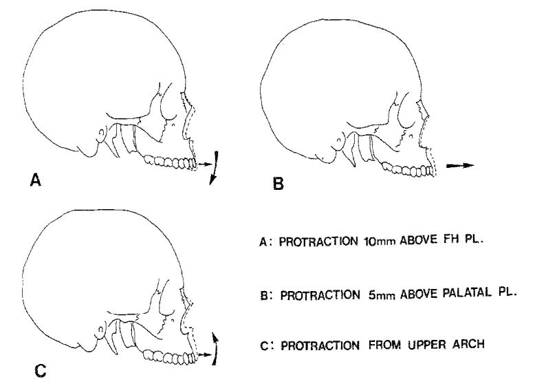 Các dạng chuyển động khác nhau của xương hàm trên